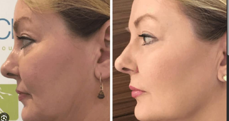 Hydra Facial